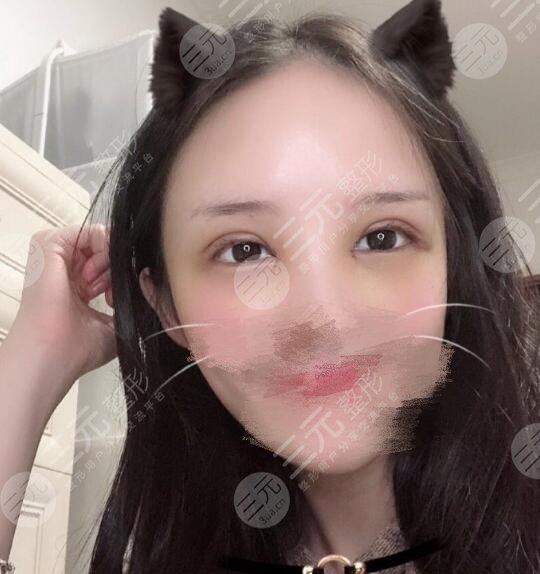 整形美容科双眼皮案例