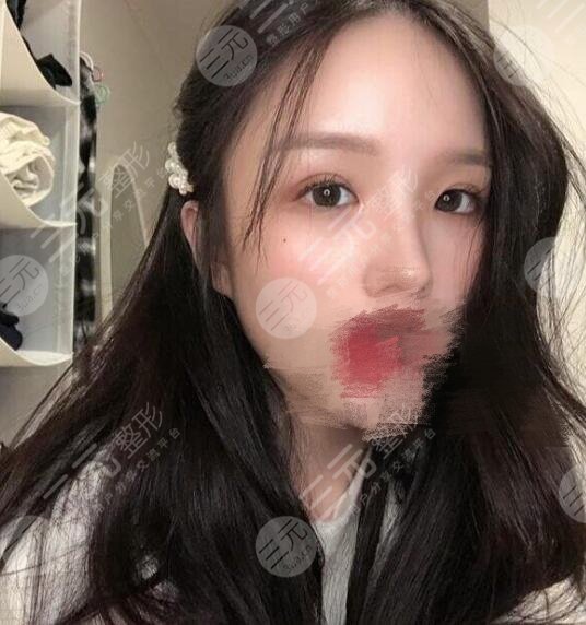 整形美容科双眼皮案例