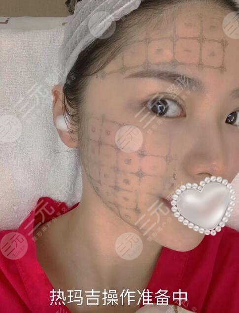 广州南方医院热玛吉果图