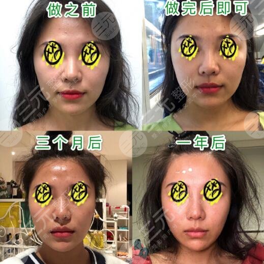 深圳北大医院热玛吉果图