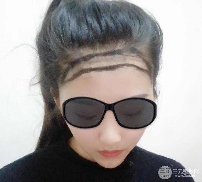 沈阳碧莲盛植发医院案例分享