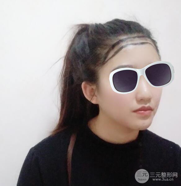 沈阳碧莲盛植发医院案例分享