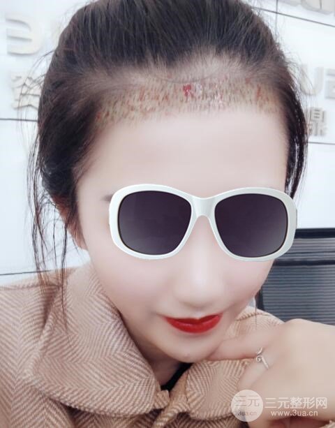 沈阳碧莲盛植发医院案例分享