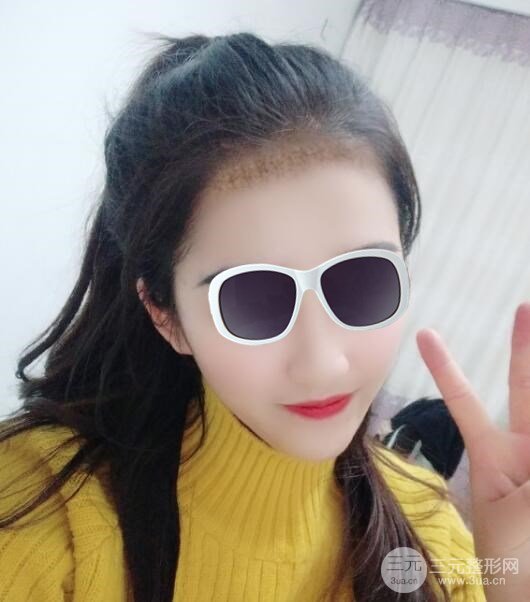 沈阳碧莲盛植发医院案例分享