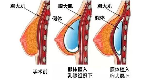 蜜桃假体隆胸的优点