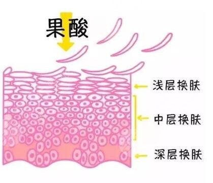 果酸换肤要多少钱?