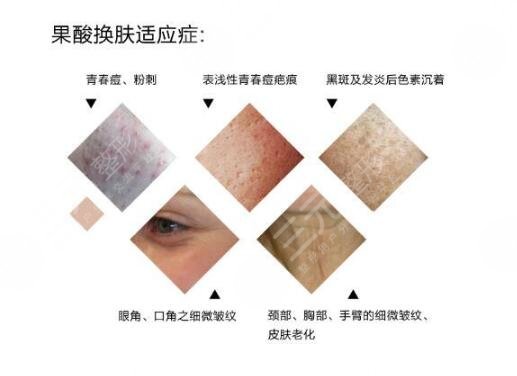 果酸换肤价格的影响因素