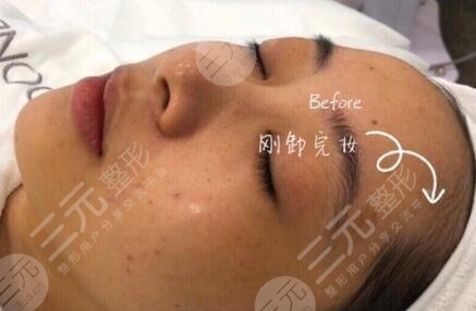 果酸换肤案例反馈