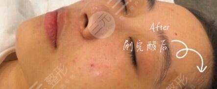 果酸换肤案例反馈