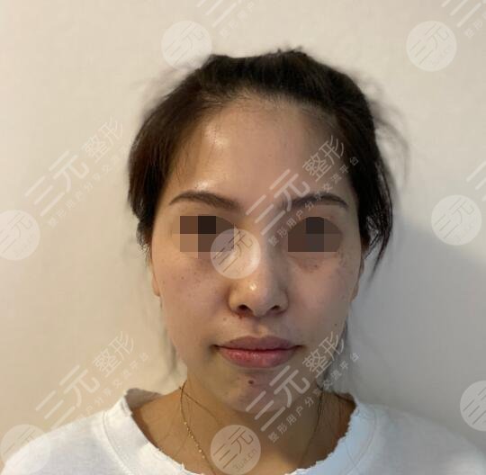 江阴中医院整形美容科祛斑案例前