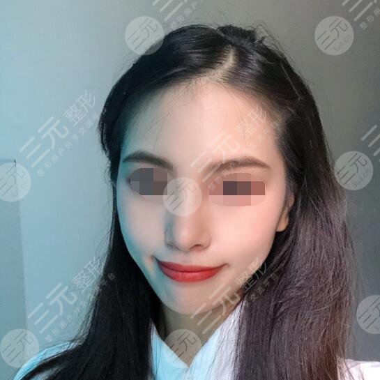 江阴中医院整形美容科祛斑案例后