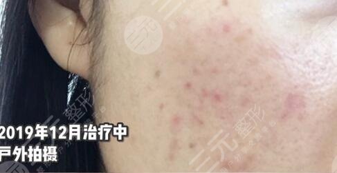 厦门中医院皮肤美容科祛痘前