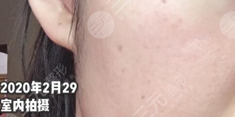 厦门中医院皮肤美容科祛痘后