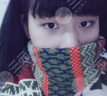 成都八大处割双眼皮前