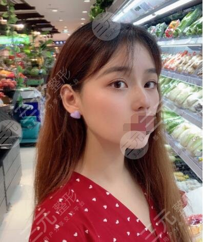 成都八大处割双眼皮后