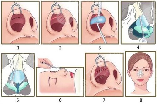 做隆鼻手术之前