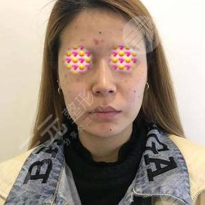 南华大学附属南华医院点痣果图