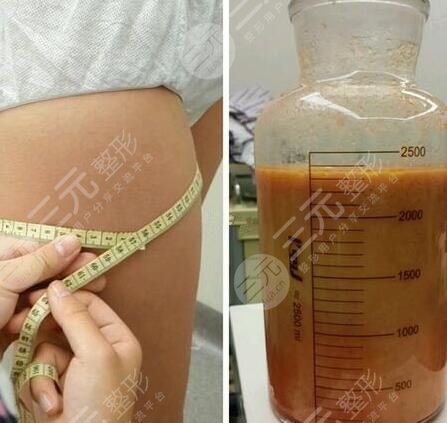 腿粗抽脂前准备