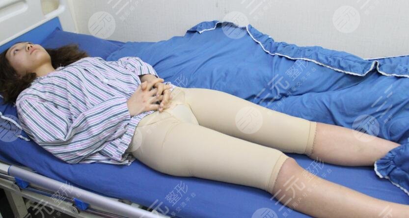 腿部吸脂塑形时间