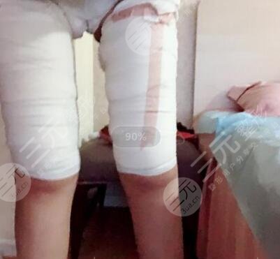 腿粗抽脂塑形果
