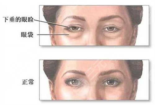 上海九院整形眼袋手术前