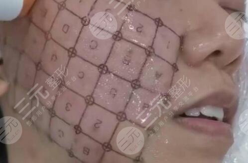 热玛吉果怎么样?