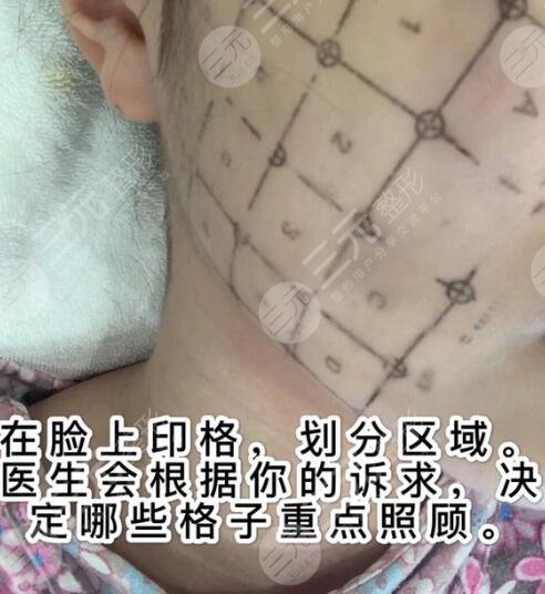 热玛吉治疗时疼吗?