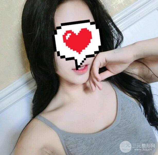 隆胸案例