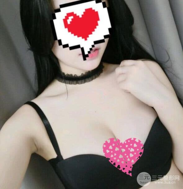 隆胸案例