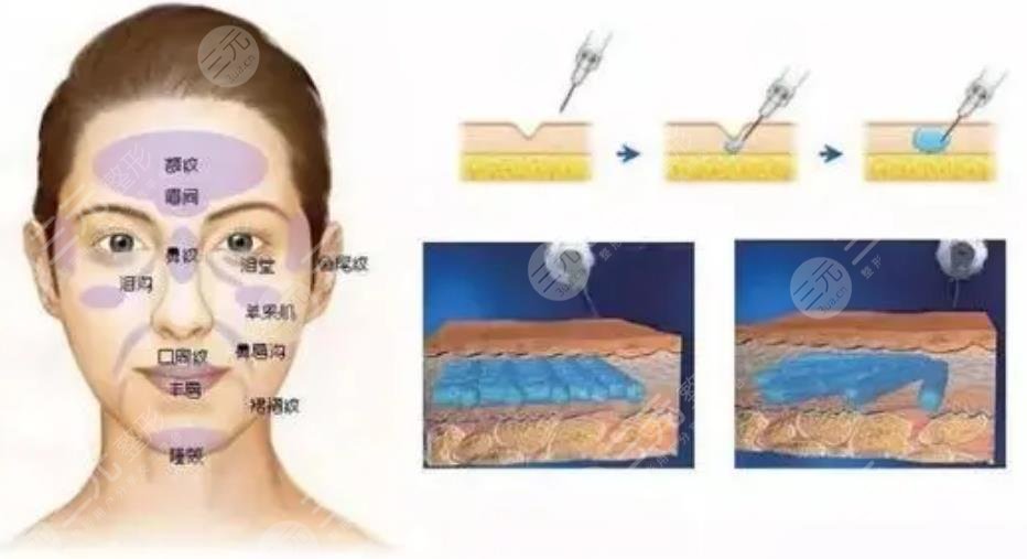 去鱼尾纹原理
