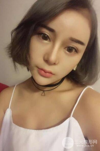 徐州四院整形美容科案例介绍