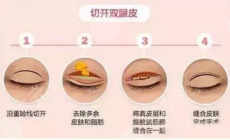 天津长征医院医美双眼皮整形经历分享