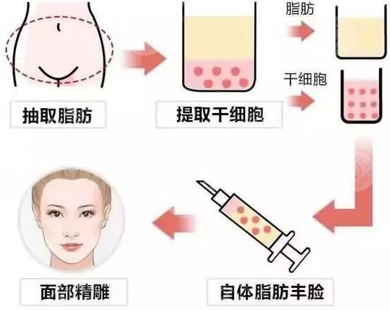 中信惠州医院美容整形科自体脂肪填充前