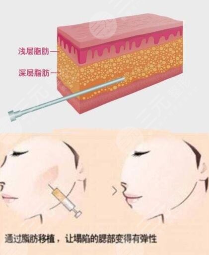 中信惠州医院美容整形科自体脂肪填充后一个月