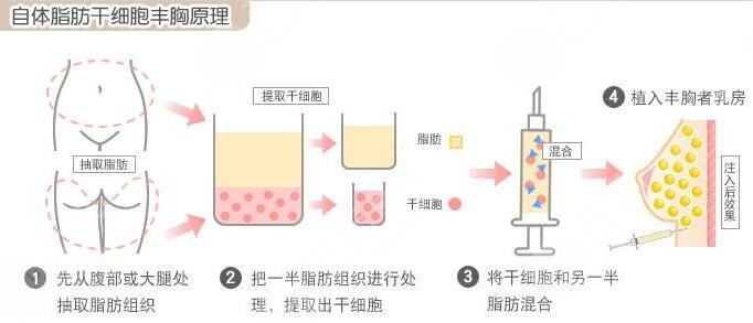 中信惠州医院美容整形科自体脂肪填充后3个月