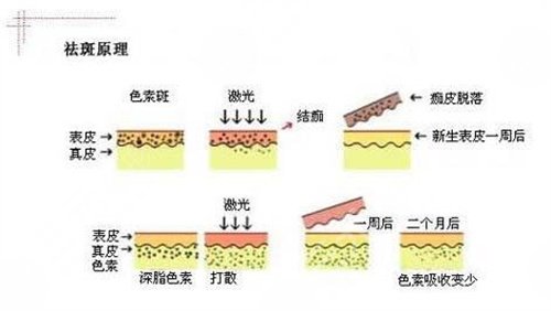 激光点痣案例