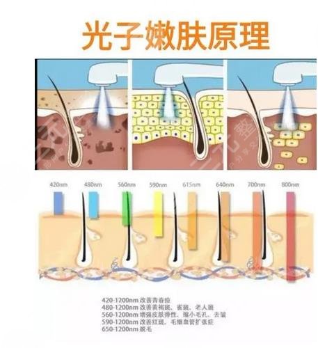 光子嫩肤手术原理