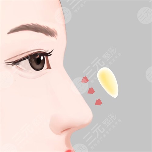 沈阳杏林美容院隆鼻果前