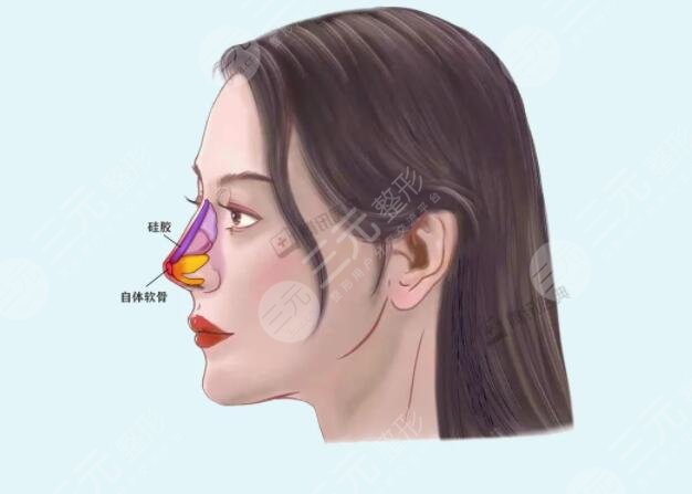 做隆鼻手术注意事项