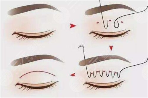 深圳梁大宁医生解答常见双眼皮修复问题