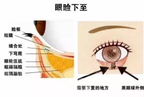 眼睑下至手术