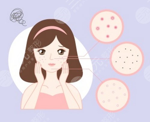 上海九院光子嫩肤案例后