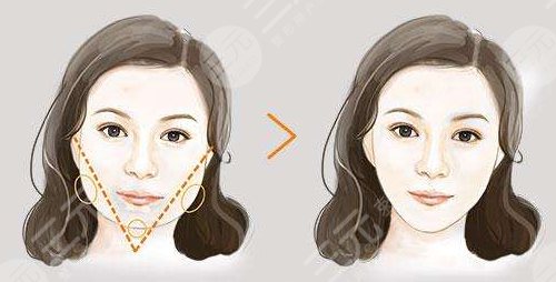 北京八大处改脸型后3个月