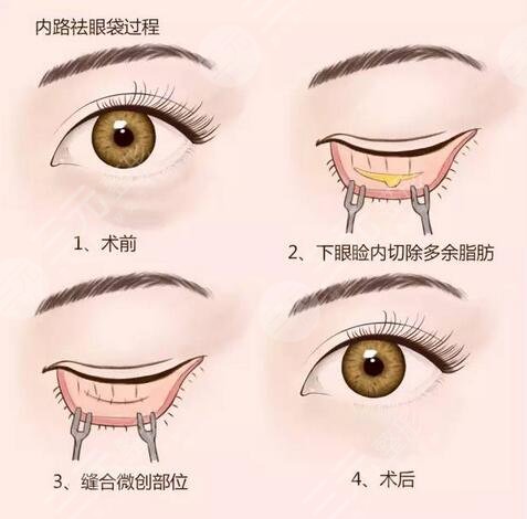 去眼袋案例前