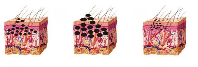 上海九院激光很贵吗？祛斑案例|价目表