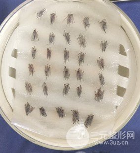 昆明正规医院植发价格表