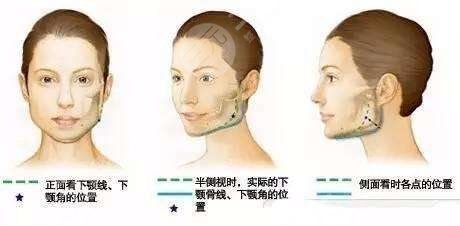 周彦恒正畸果