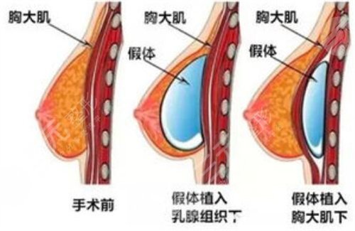 上海星璨整形医院胸部整形案例