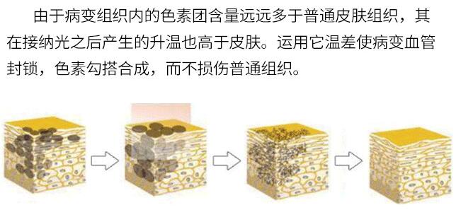 西京医院皮肤科讲解激光祛斑