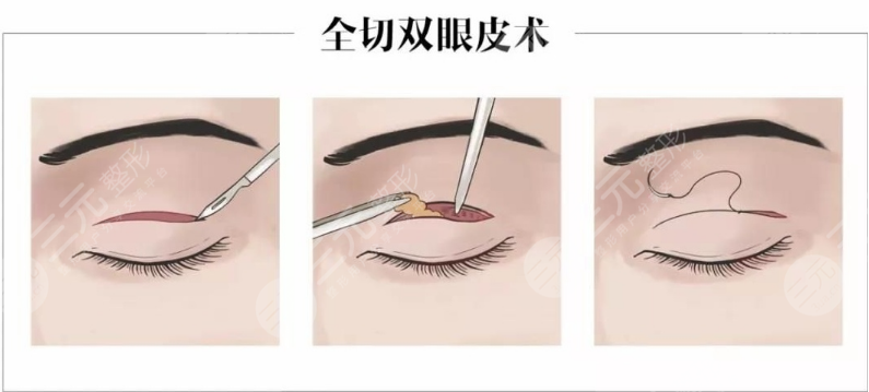 西京医院双眼皮前